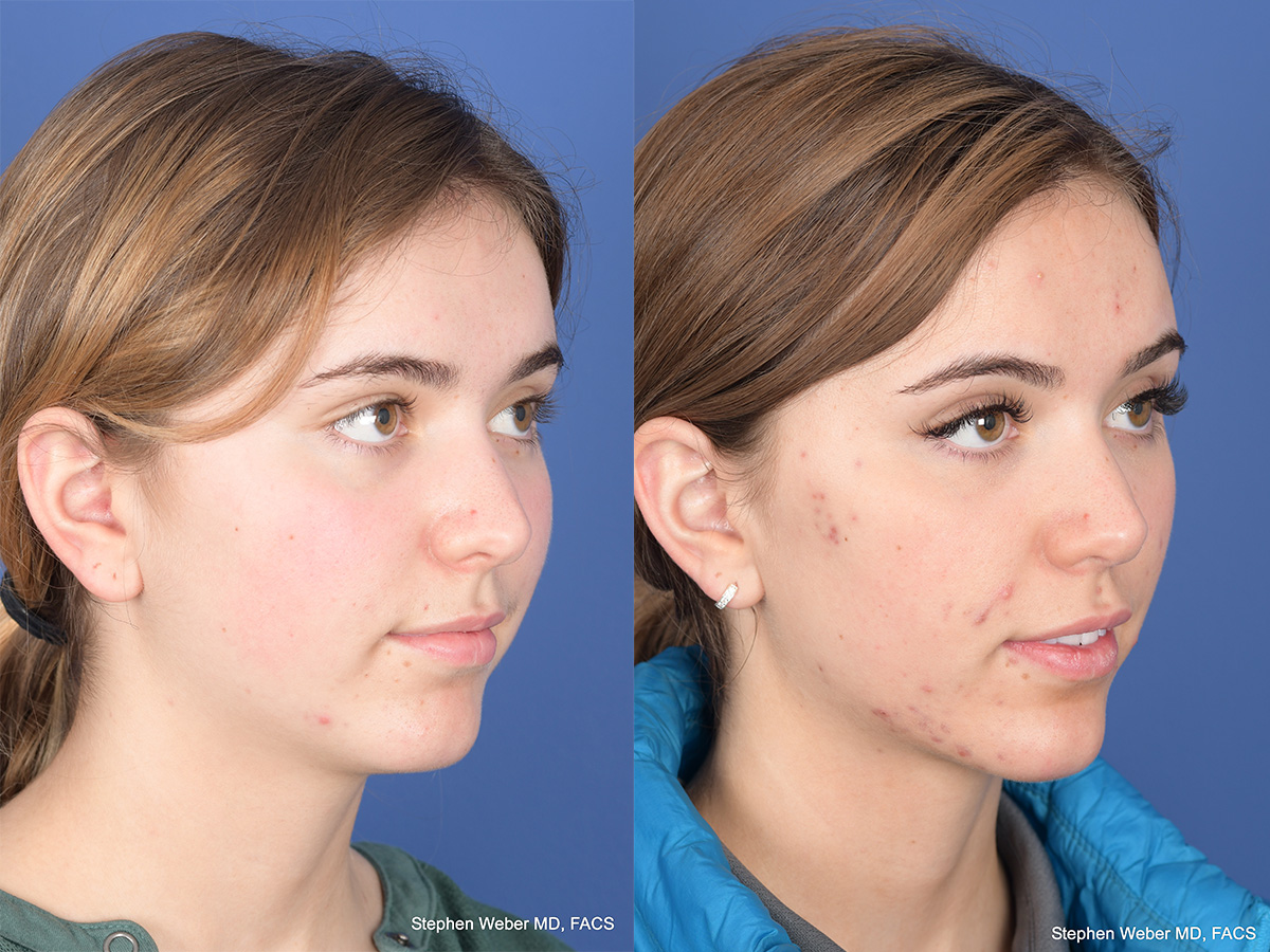 Rhinoplasty Before and After | Weber Facial Plastic Surgery
