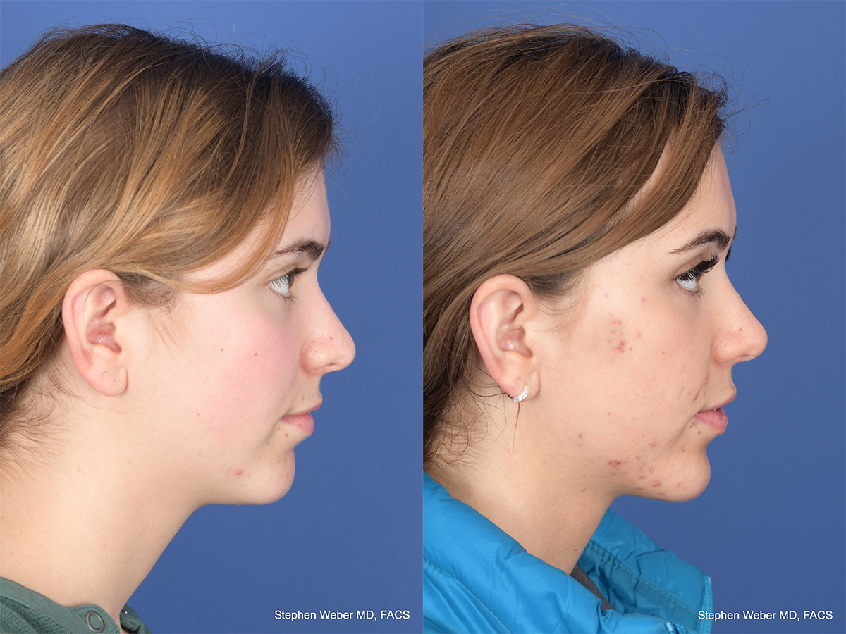 Rhinoplasty Before and After | Weber Facial Plastic Surgery