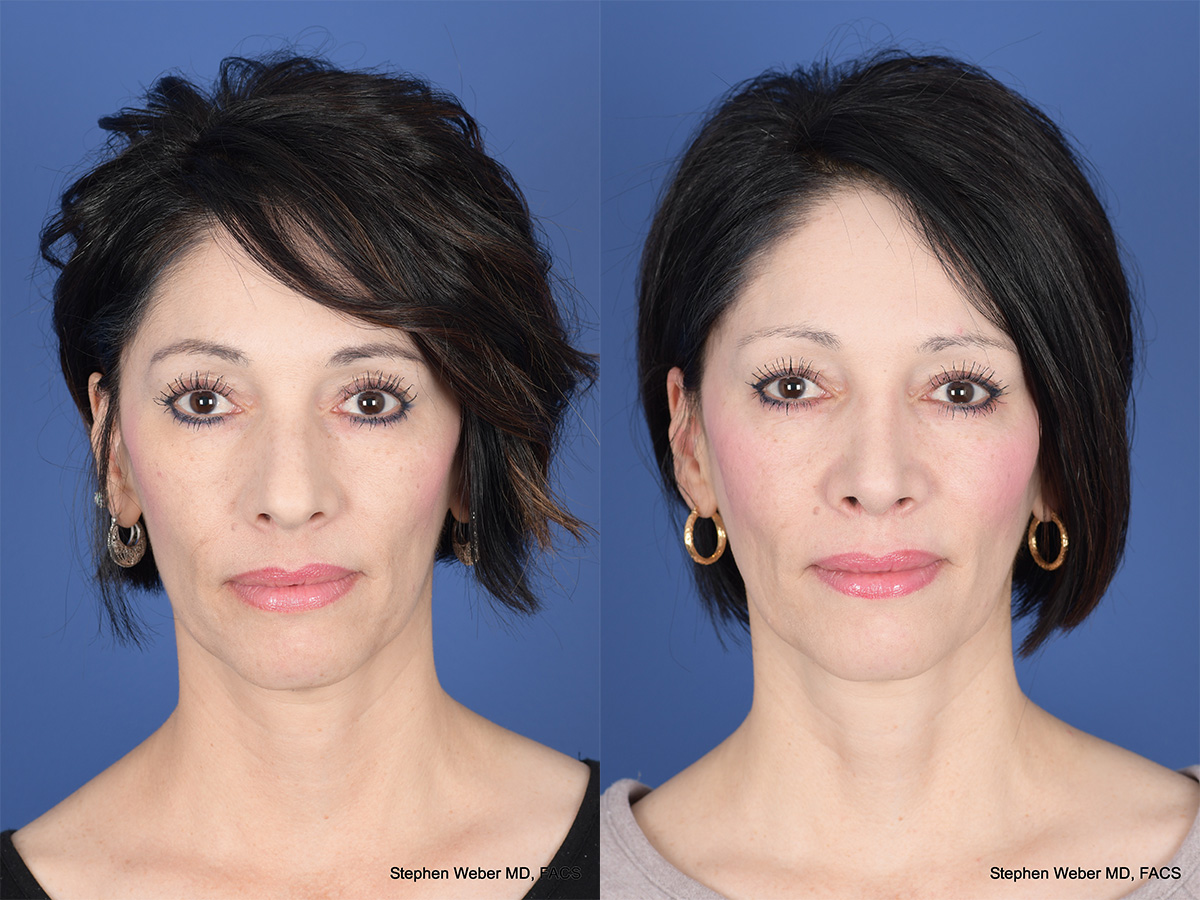 Rhinoplasty Before and After | Weber Facial Plastic Surgery