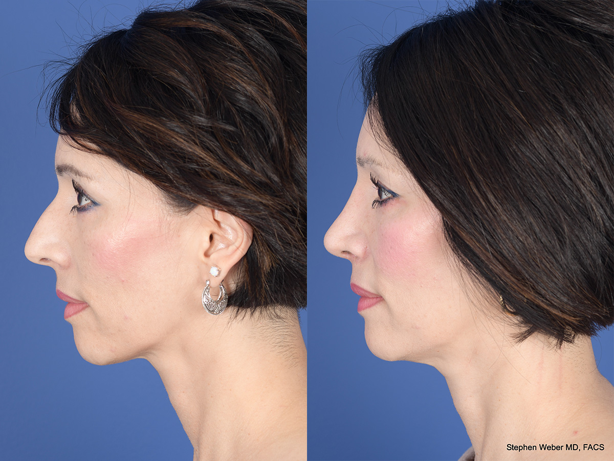 Rhinoplasty Before and After | Weber Facial Plastic Surgery