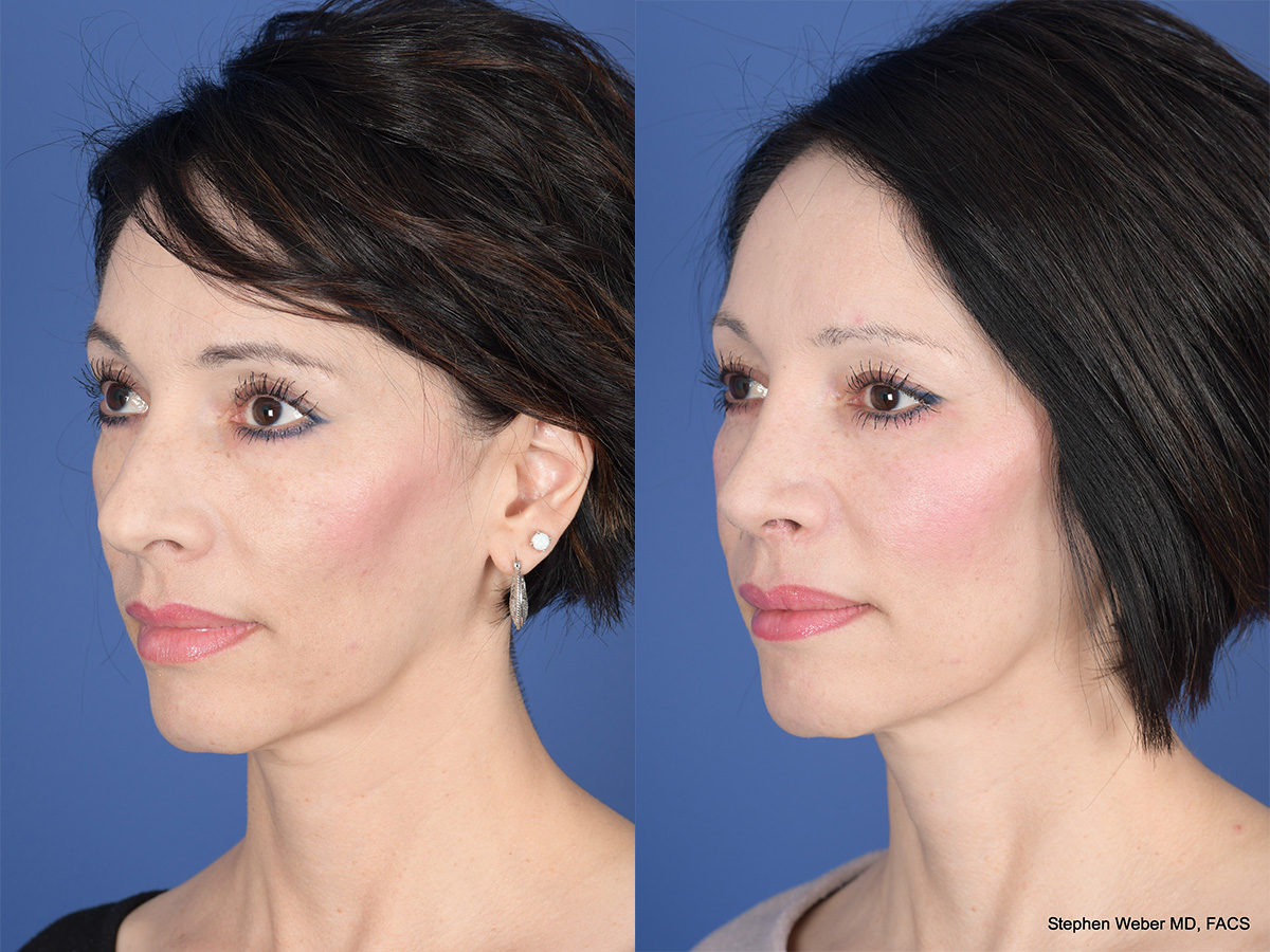 Rhinoplasty Before and After | Weber Facial Plastic Surgery