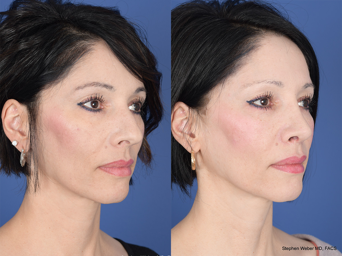 Rhinoplasty Before and After | Weber Facial Plastic Surgery