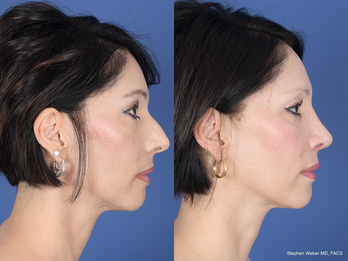 Rhinoplasty Before and After | Weber Facial Plastic Surgery