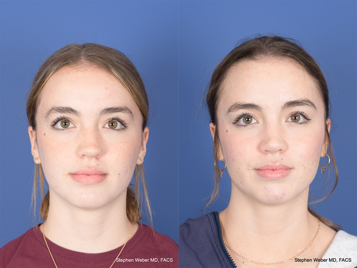 Rhinoplasty Before and After | Weber Facial Plastic Surgery
