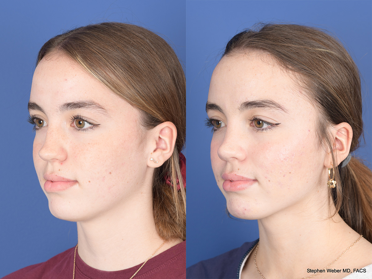 Rhinoplasty Before and After | Weber Facial Plastic Surgery