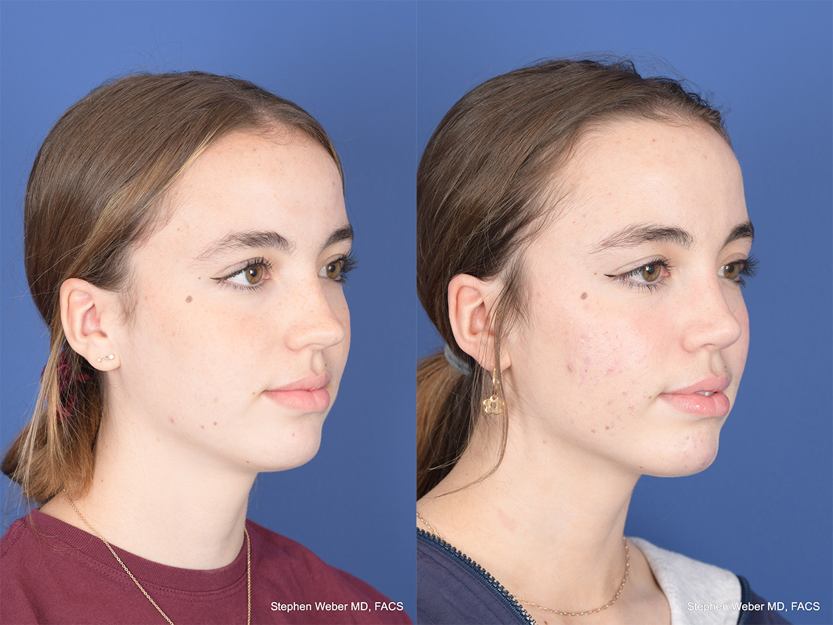 Rhinoplasty Before and After | Weber Facial Plastic Surgery