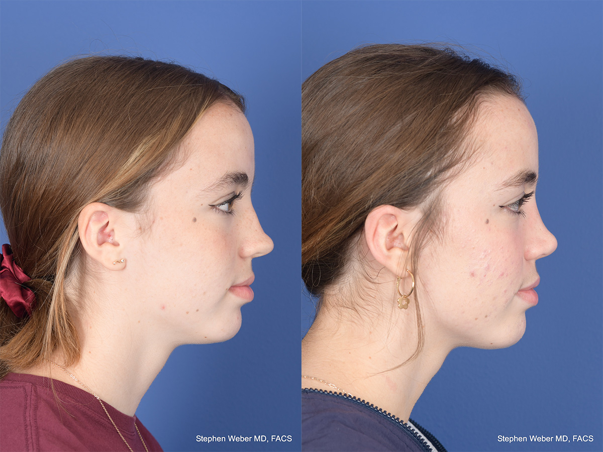Rhinoplasty Before and After | Weber Facial Plastic Surgery