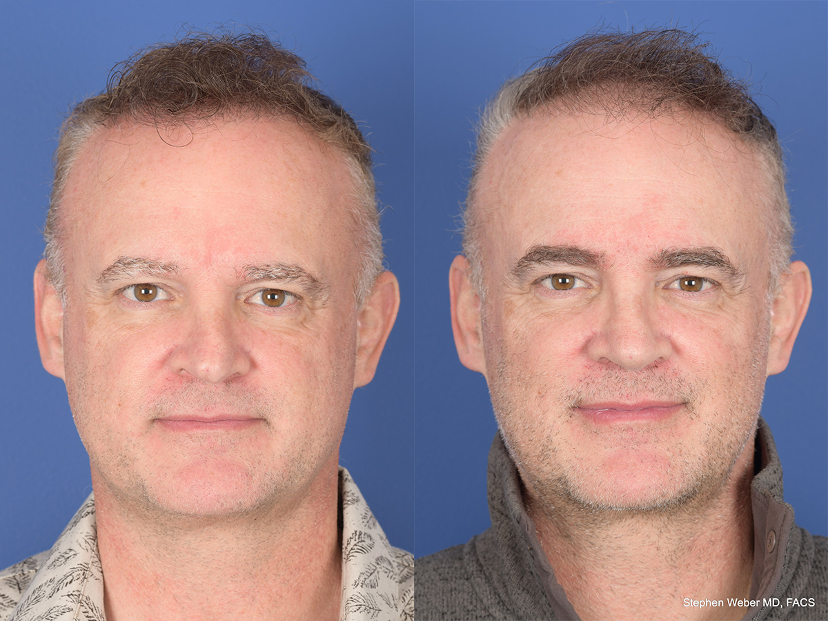 Rhinoplasty Before and After | Weber Facial Plastic Surgery