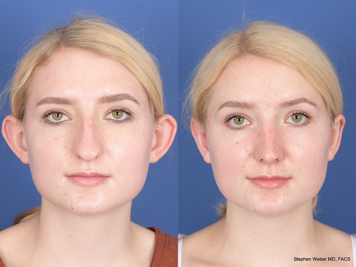 Rhinoplasty Before and After | Weber Facial Plastic Surgery