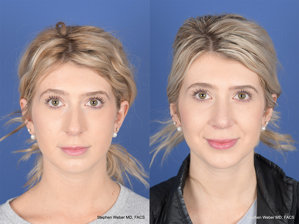 Rhinoplasty Before and After | Weber Facial Plastic Surgery