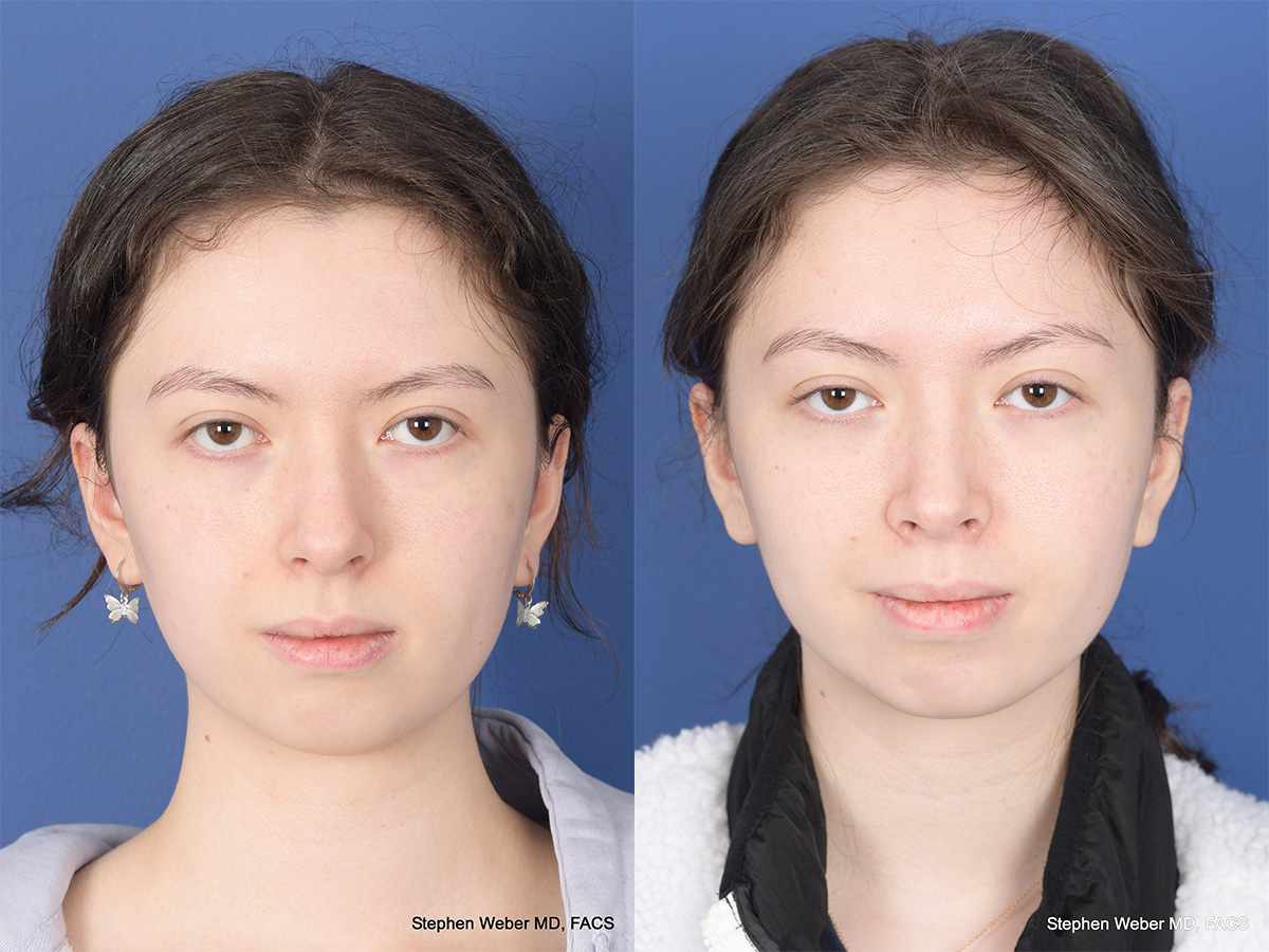 Rhinoplasty Before and After | Weber Facial Plastic Surgery