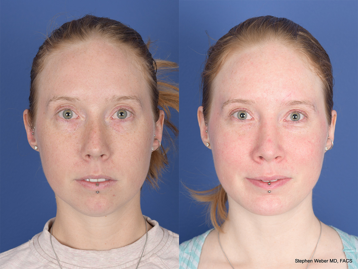 Rhinoplasty Before and After | Weber Facial Plastic Surgery