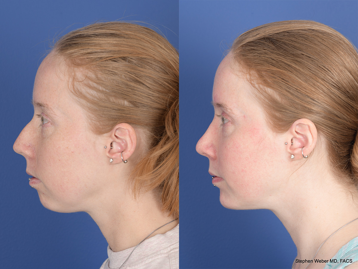 Rhinoplasty Before and After | Weber Facial Plastic Surgery
