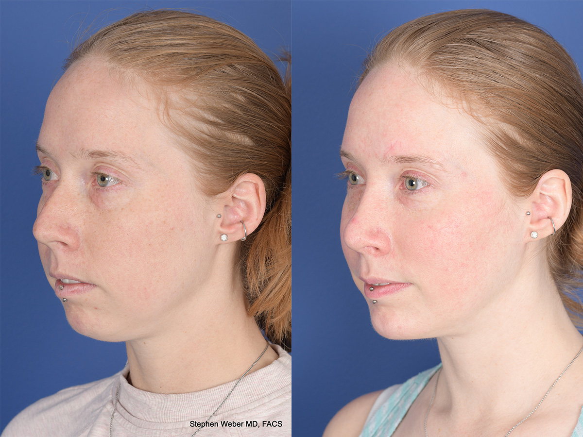 Rhinoplasty Before and After | Weber Facial Plastic Surgery