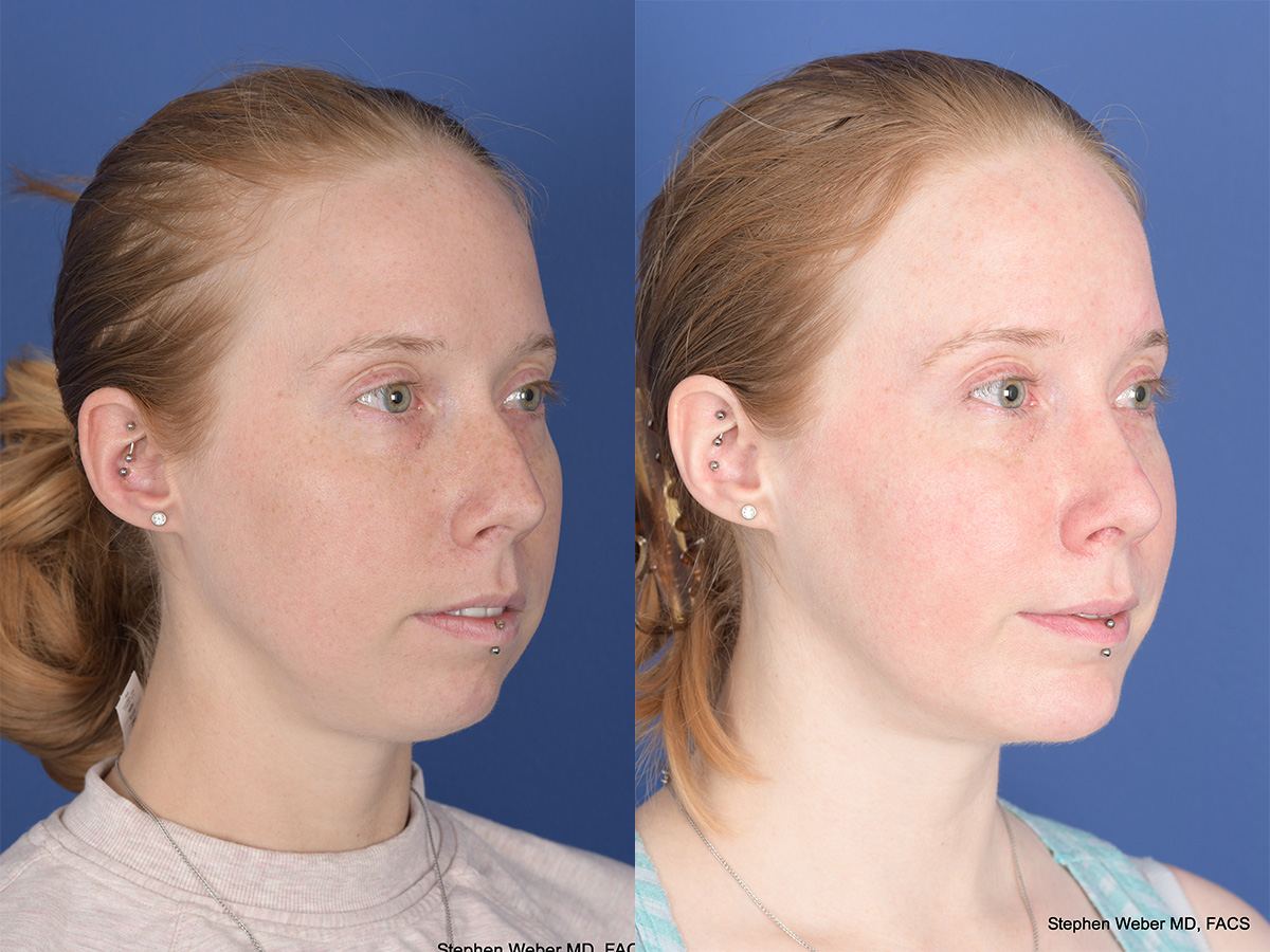 Rhinoplasty Before and After | Weber Facial Plastic Surgery