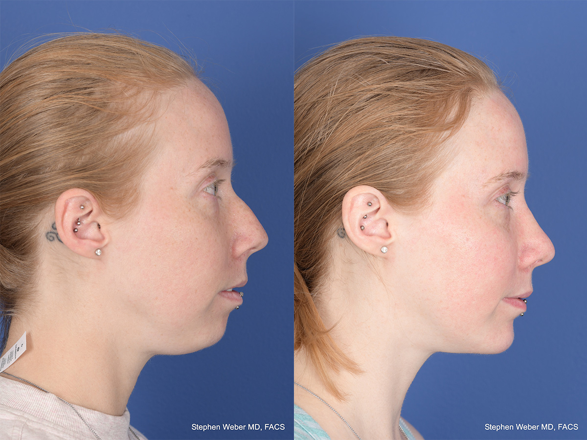 Rhinoplasty Before and After | Weber Facial Plastic Surgery