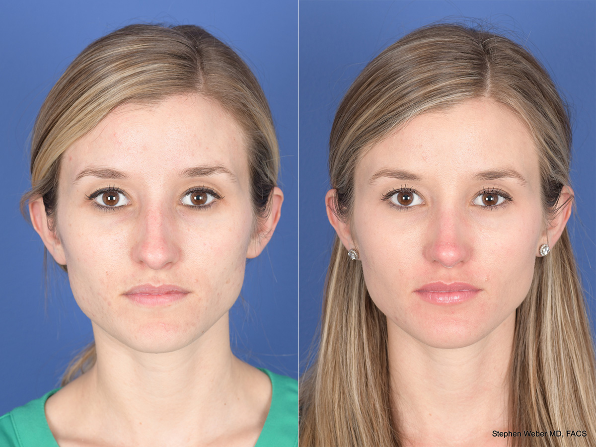 Rhinoplasty Before and After | Weber Facial Plastic Surgery