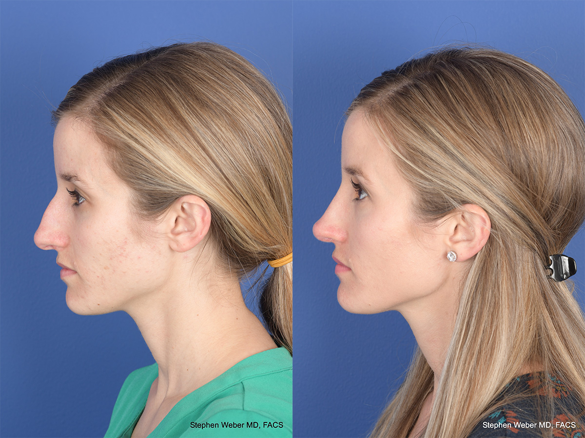 Rhinoplasty Before and After | Weber Facial Plastic Surgery