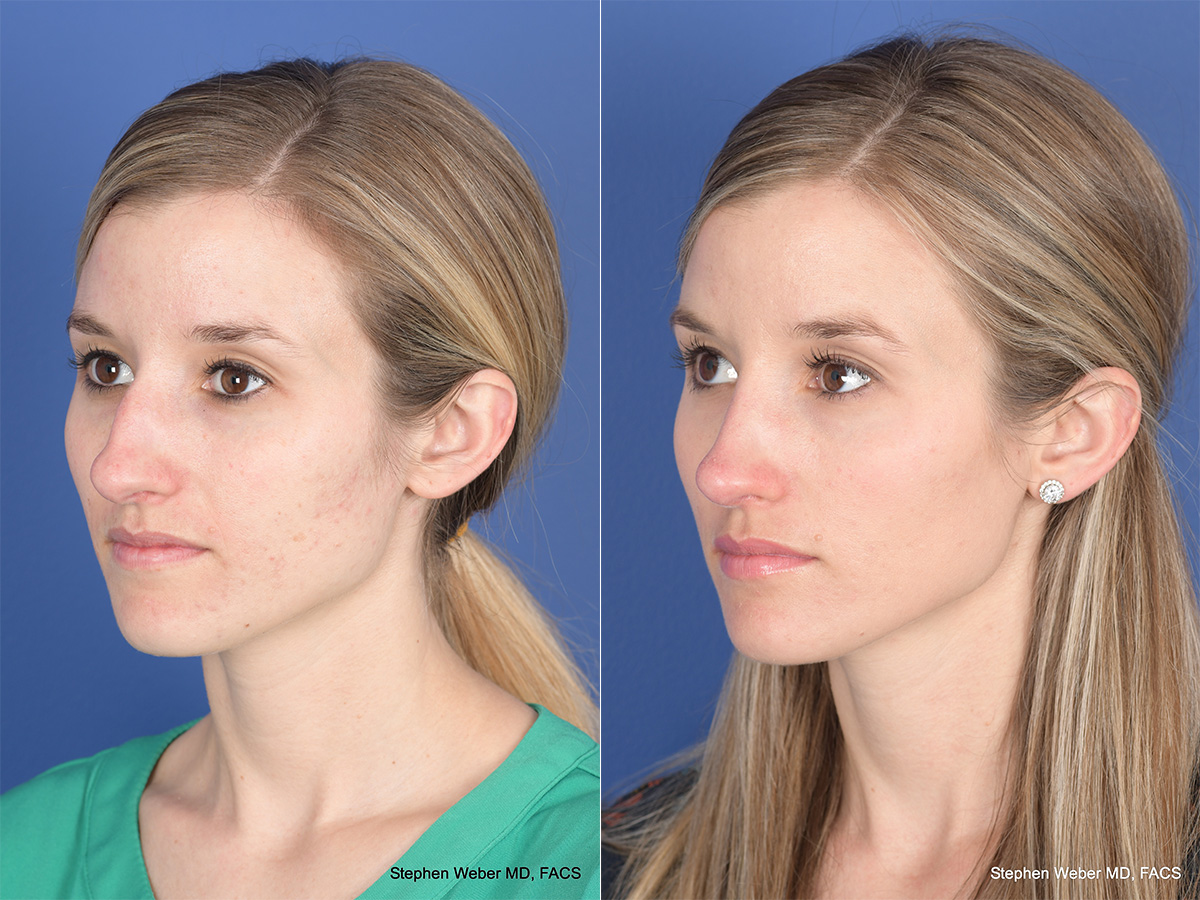 Rhinoplasty Before and After | Weber Facial Plastic Surgery