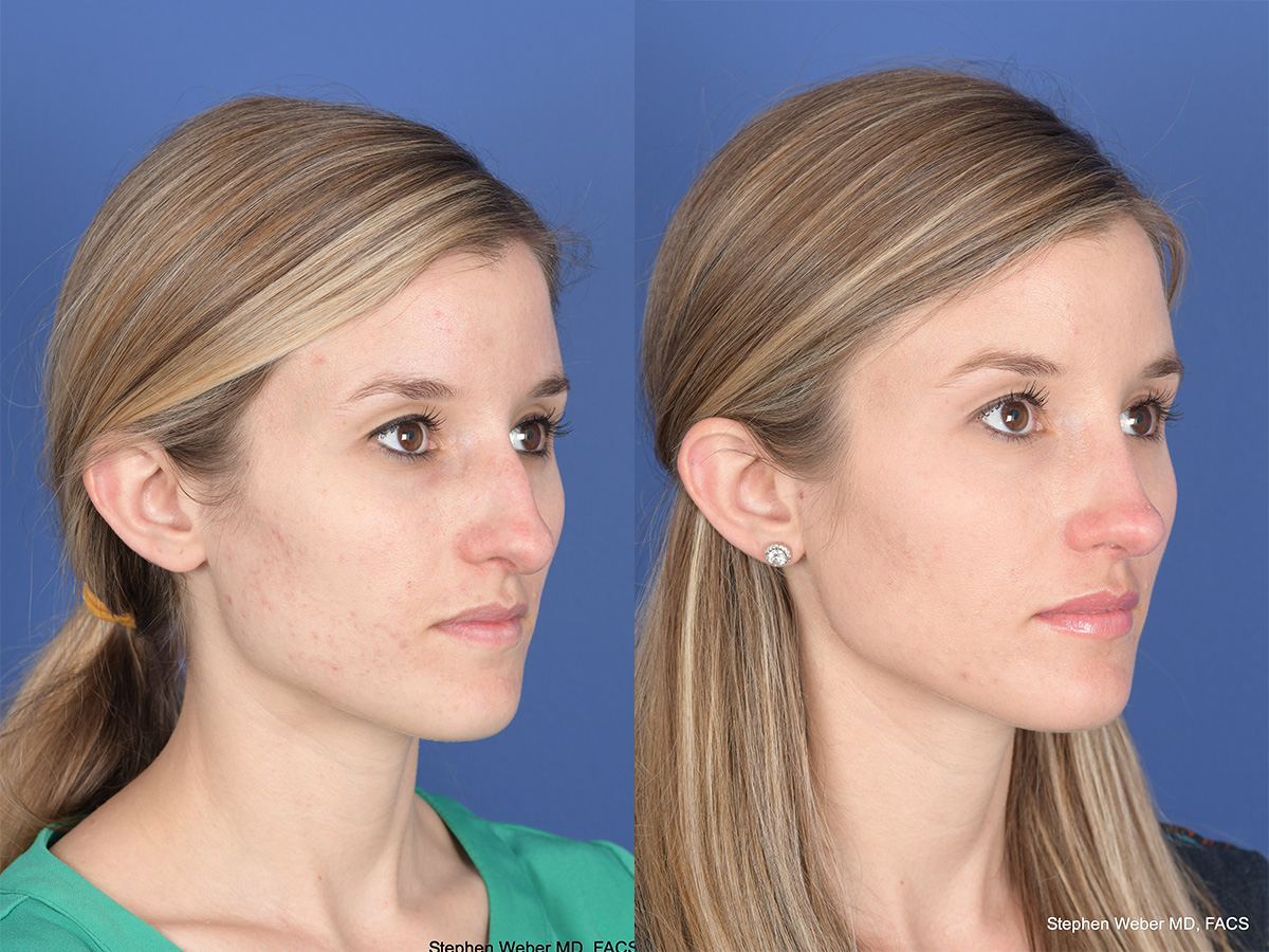 Rhinoplasty Before and After | Weber Facial Plastic Surgery
