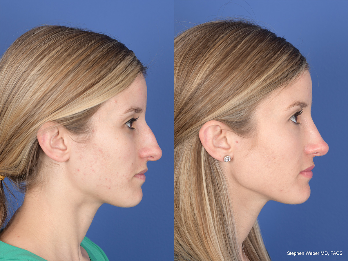 Rhinoplasty Before and After | Weber Facial Plastic Surgery