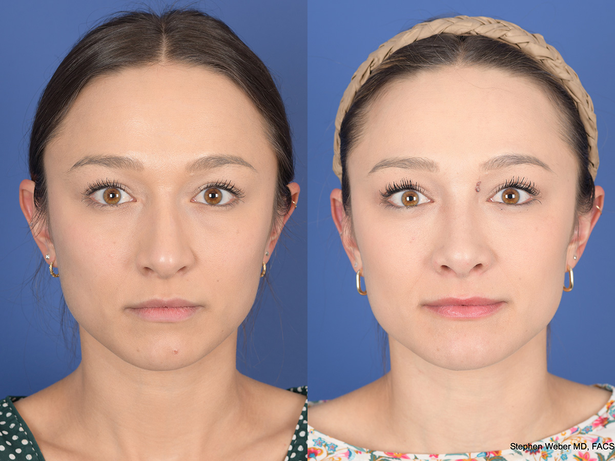 Rhinoplasty Before and After | Weber Facial Plastic Surgery
