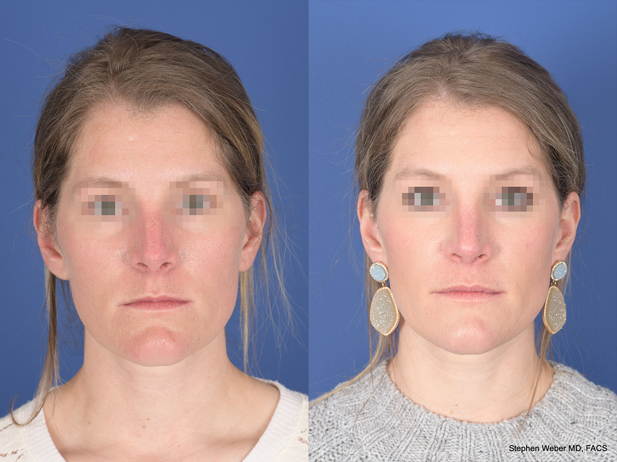 Rhinoplasty Before and After | Weber Facial Plastic Surgery