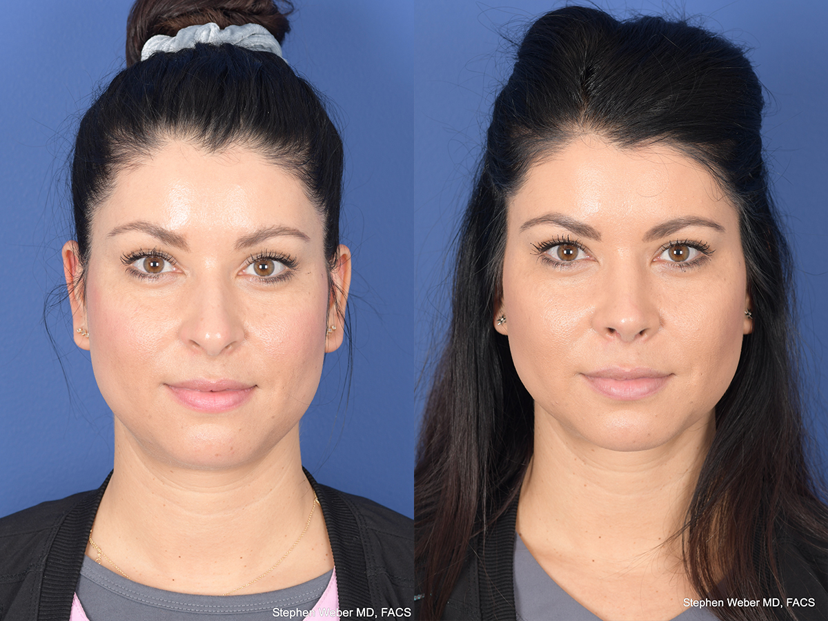 Rhinoplasty Before and After | Weber Facial Plastic Surgery