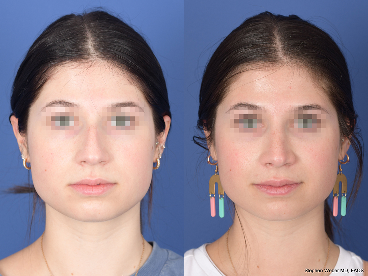 Rhinoplasty Before and After | Weber Facial Plastic Surgery