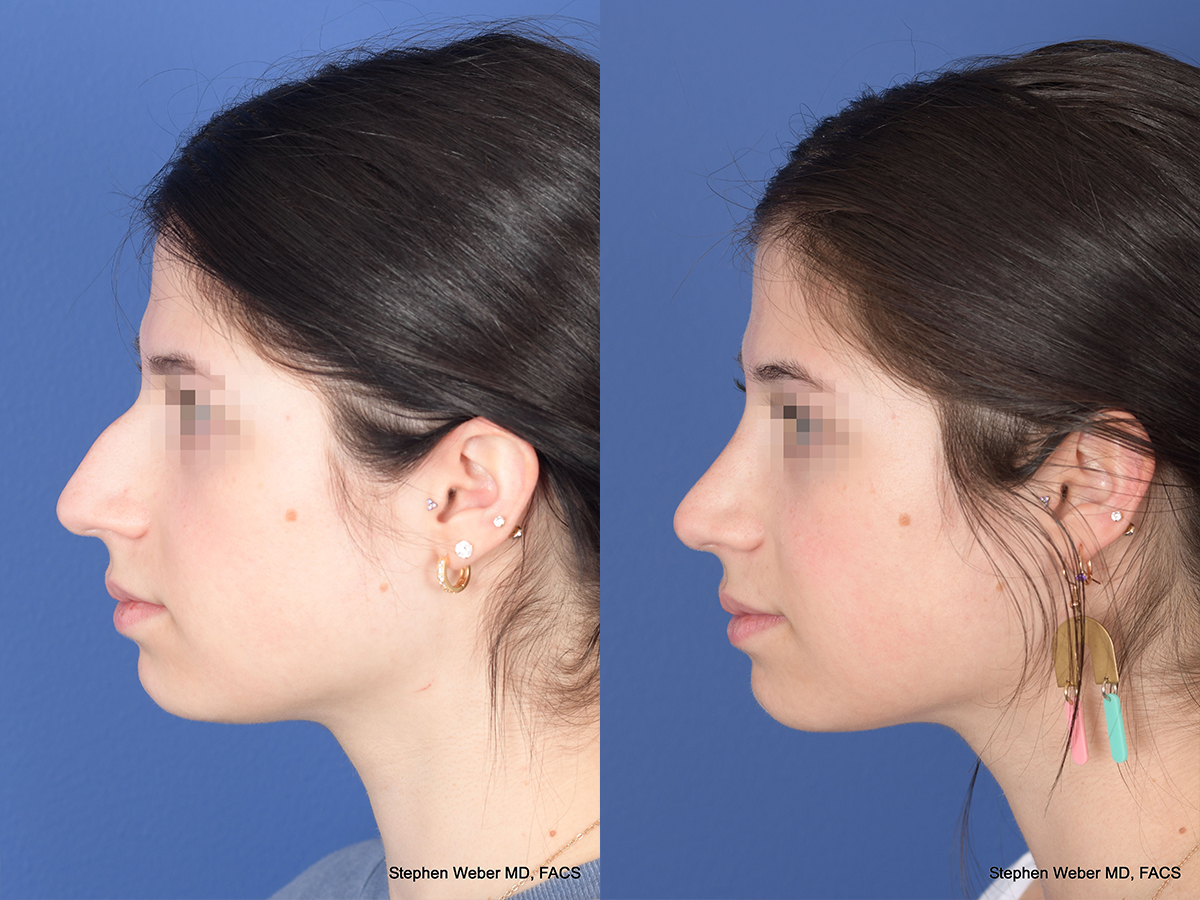 Rhinoplasty Before and After | Weber Facial Plastic Surgery