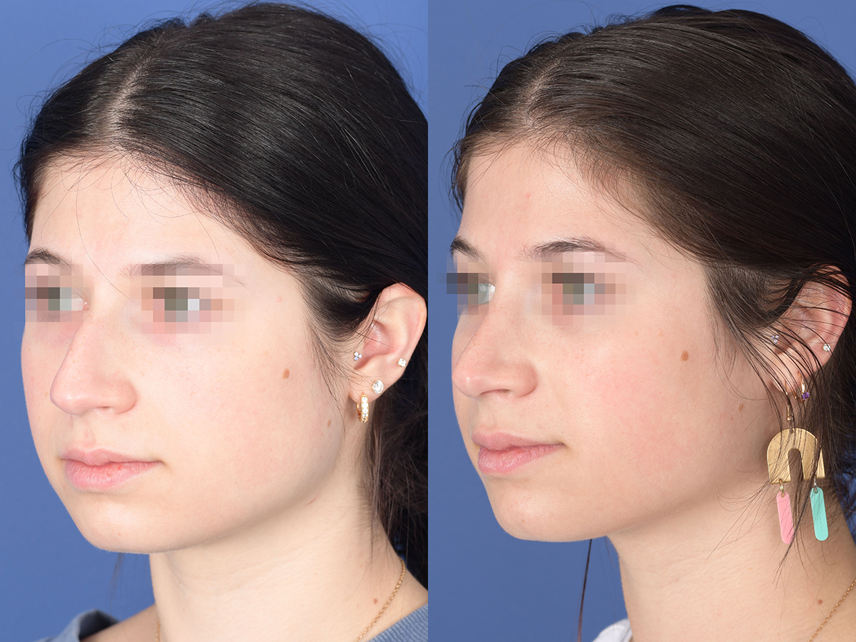 Rhinoplasty Before and After | Weber Facial Plastic Surgery