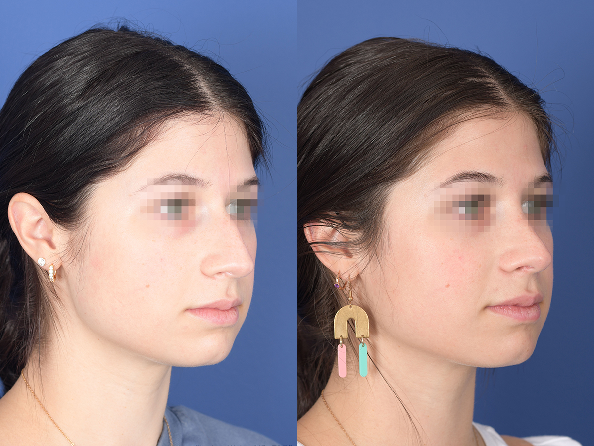 Rhinoplasty Before and After | Weber Facial Plastic Surgery