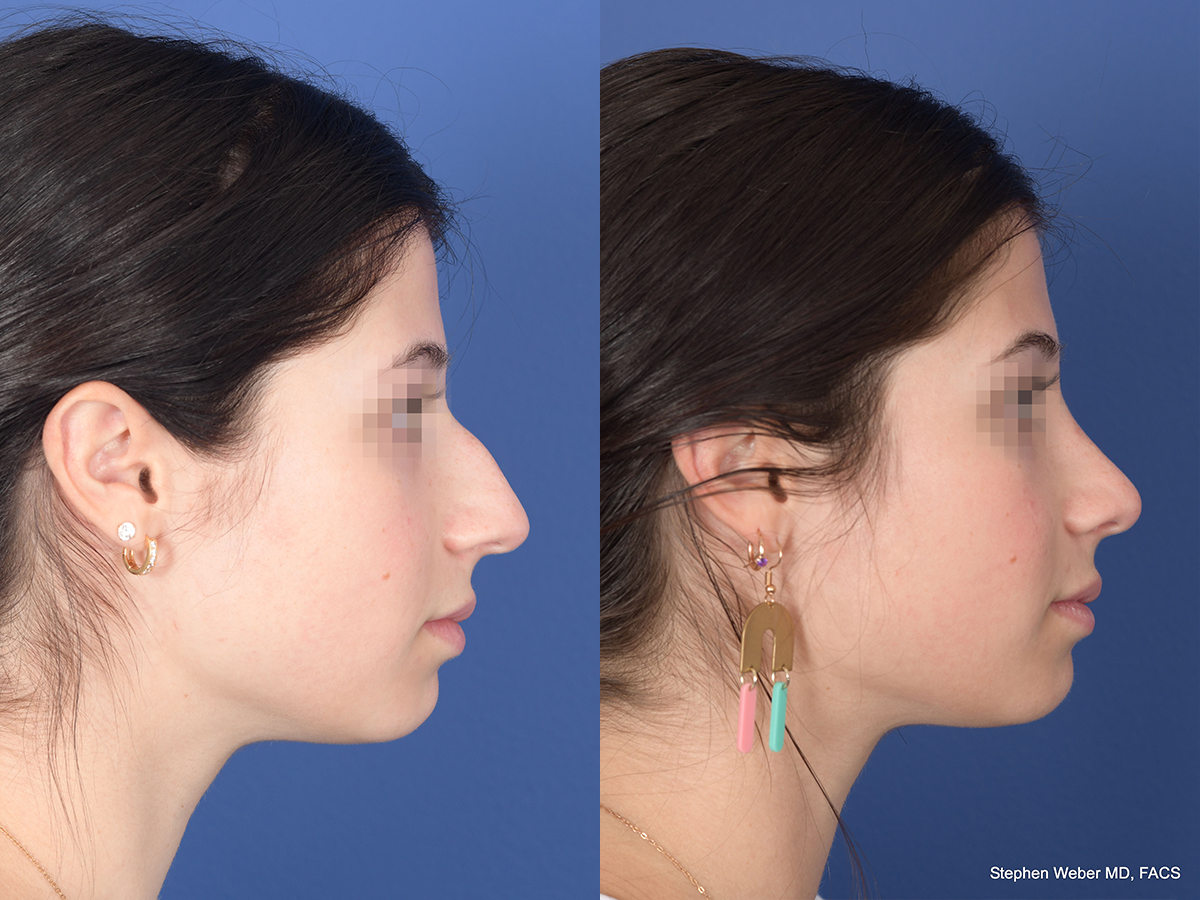 Rhinoplasty Before and After | Weber Facial Plastic Surgery