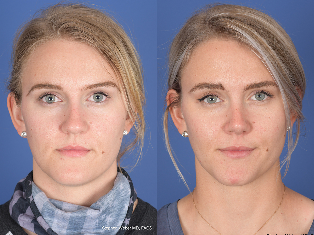Rhinoplasty Before and After | Weber Facial Plastic Surgery