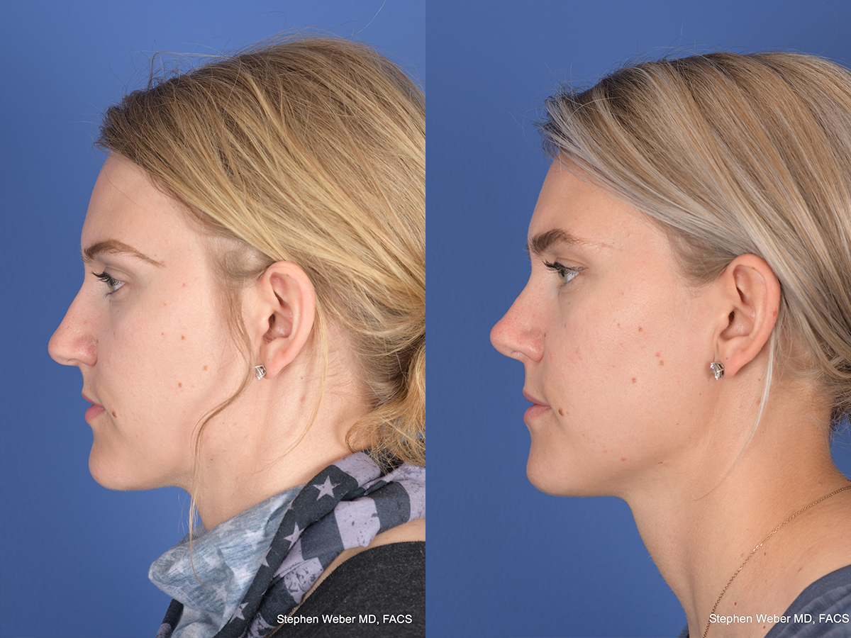 Rhinoplasty Before and After | Weber Facial Plastic Surgery