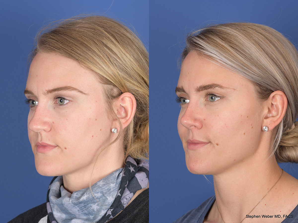 Rhinoplasty Before and After | Weber Facial Plastic Surgery