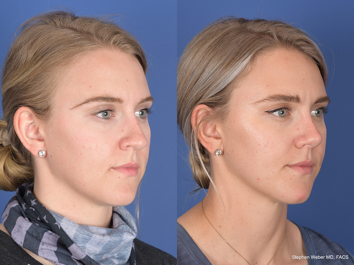 Rhinoplasty Before and After | Weber Facial Plastic Surgery
