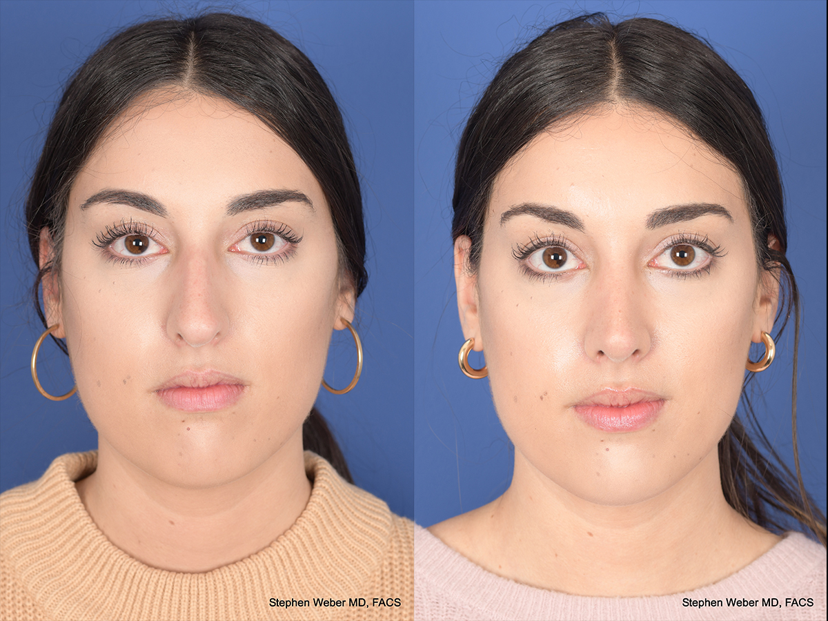 Rhinoplasty Before and After 92 Weber Facial Plastic Surgery
