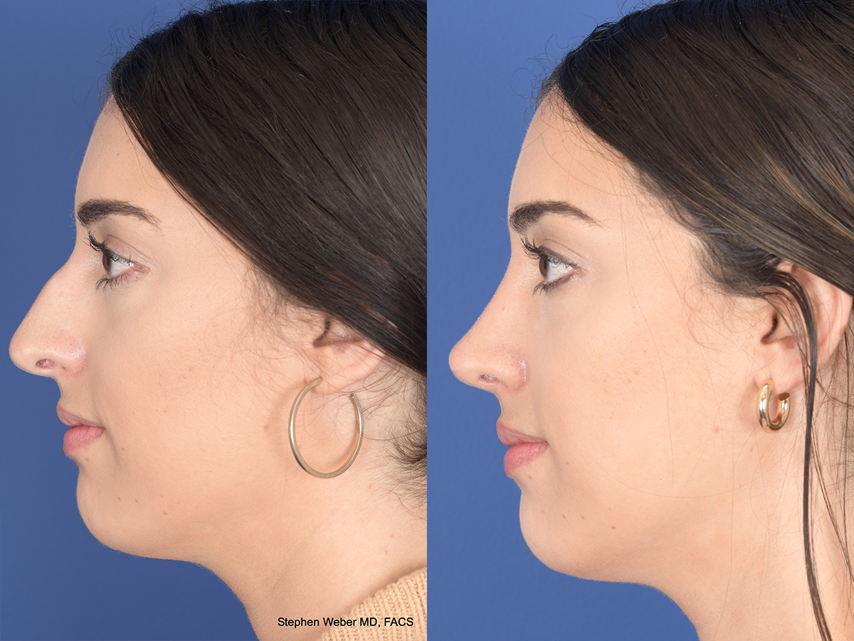 Rhinoplasty Before and After | Weber Facial Plastic Surgery