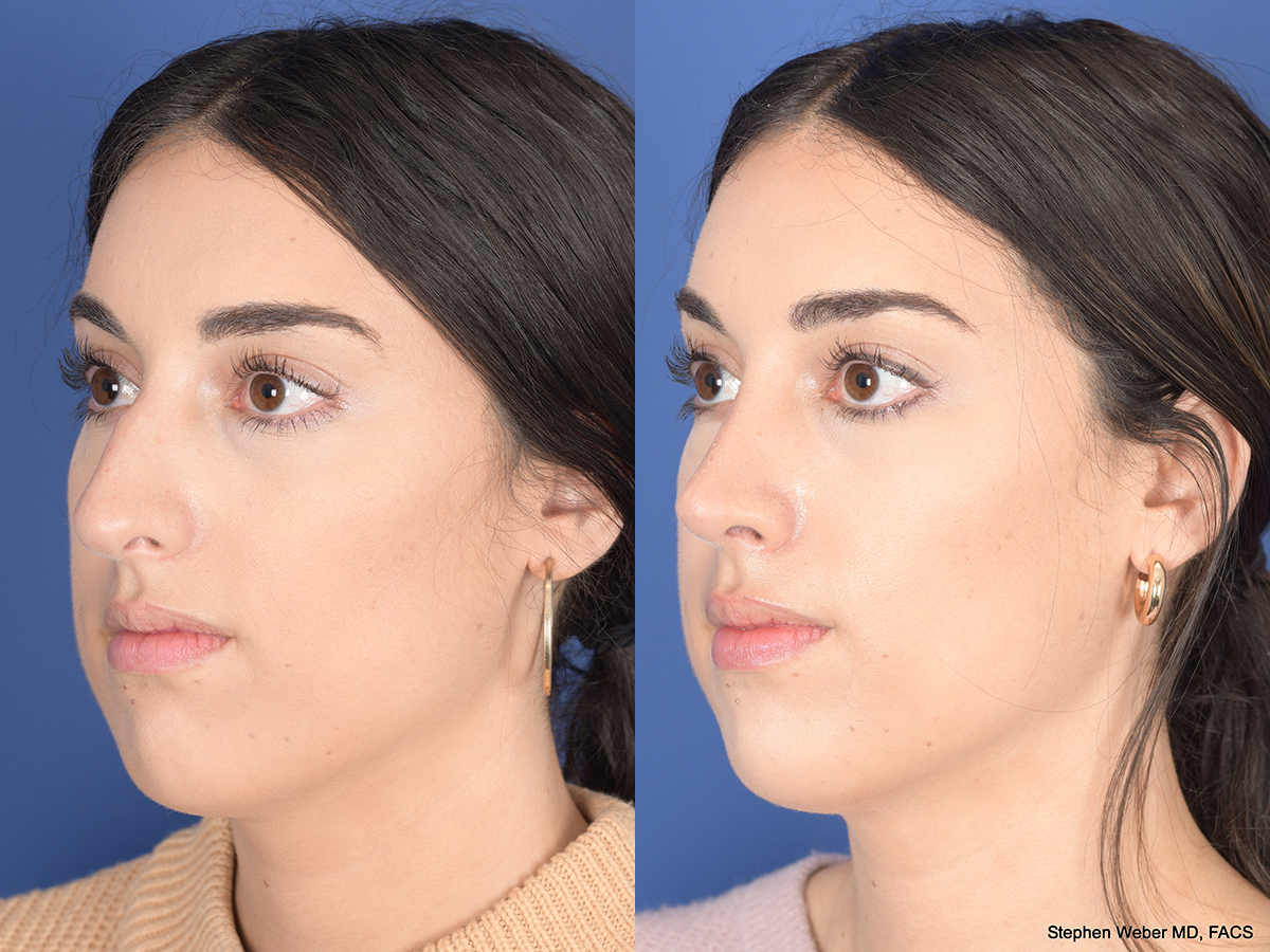Rhinoplasty Before and After | Weber Facial Plastic Surgery