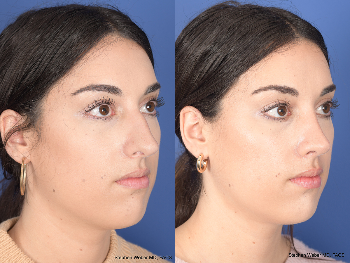 Rhinoplasty Before and After | Weber Facial Plastic Surgery