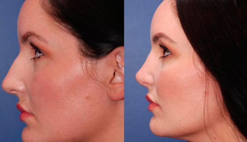 Rhinoplasty Before and After | Weber Facial Plastic Surgery