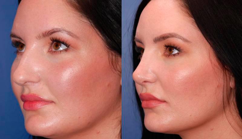 Rhinoplasty Before and After | Weber Facial Plastic Surgery