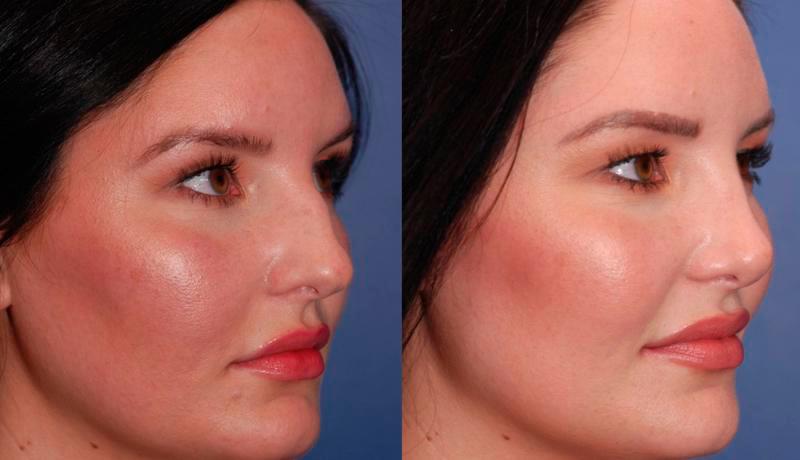 Rhinoplasty Before and After | Weber Facial Plastic Surgery