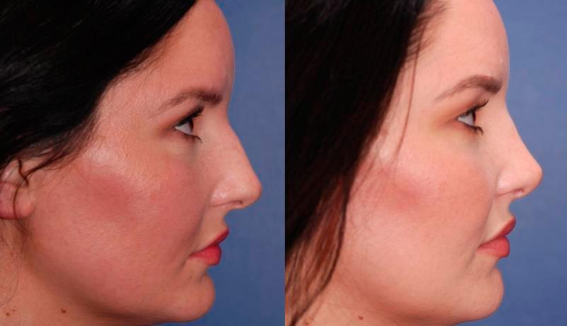 Rhinoplasty Before and After | Weber Facial Plastic Surgery