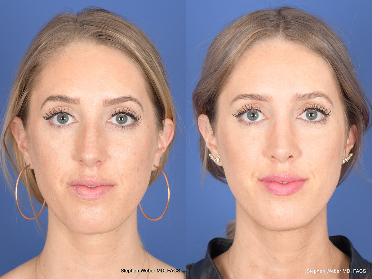 Rhinoplasty Before and After | Weber Facial Plastic Surgery
