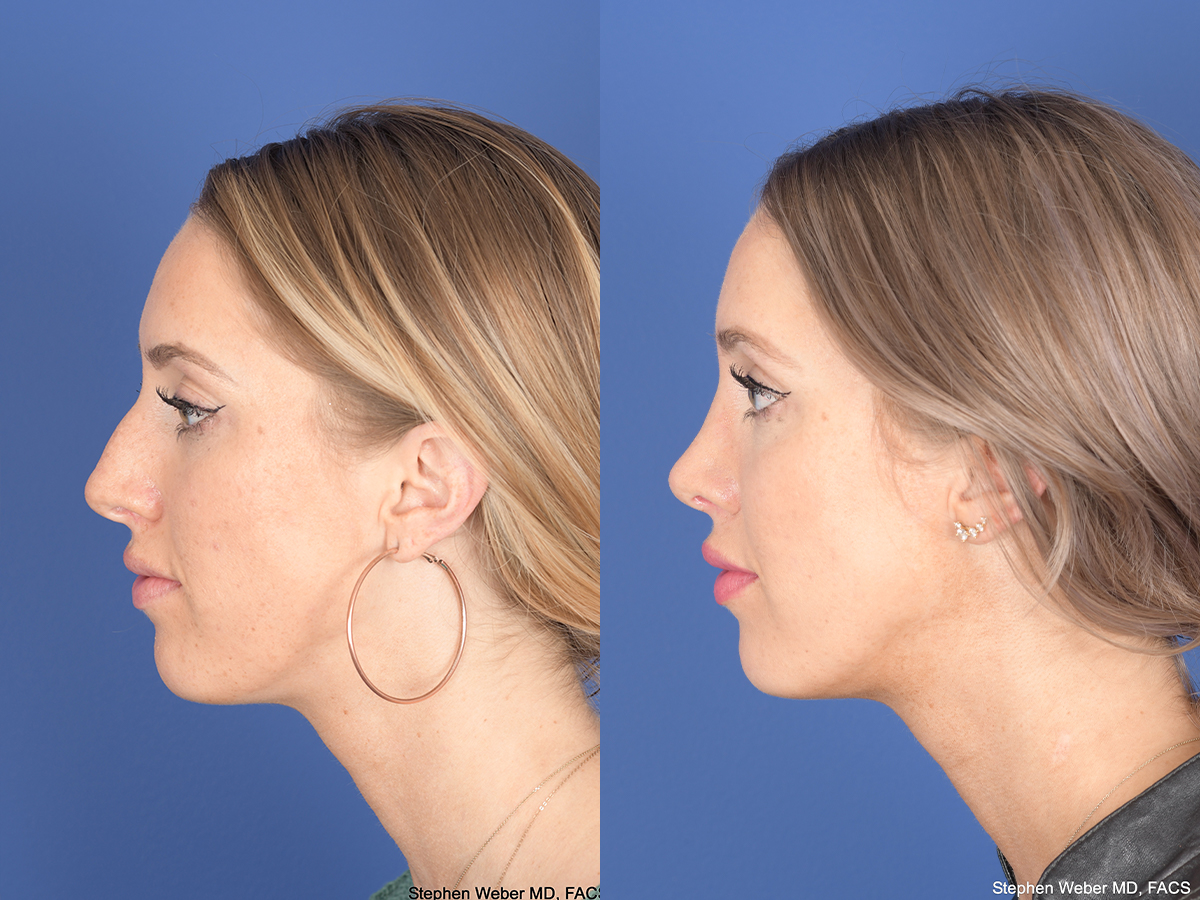 Rhinoplasty Before and After | Weber Facial Plastic Surgery
