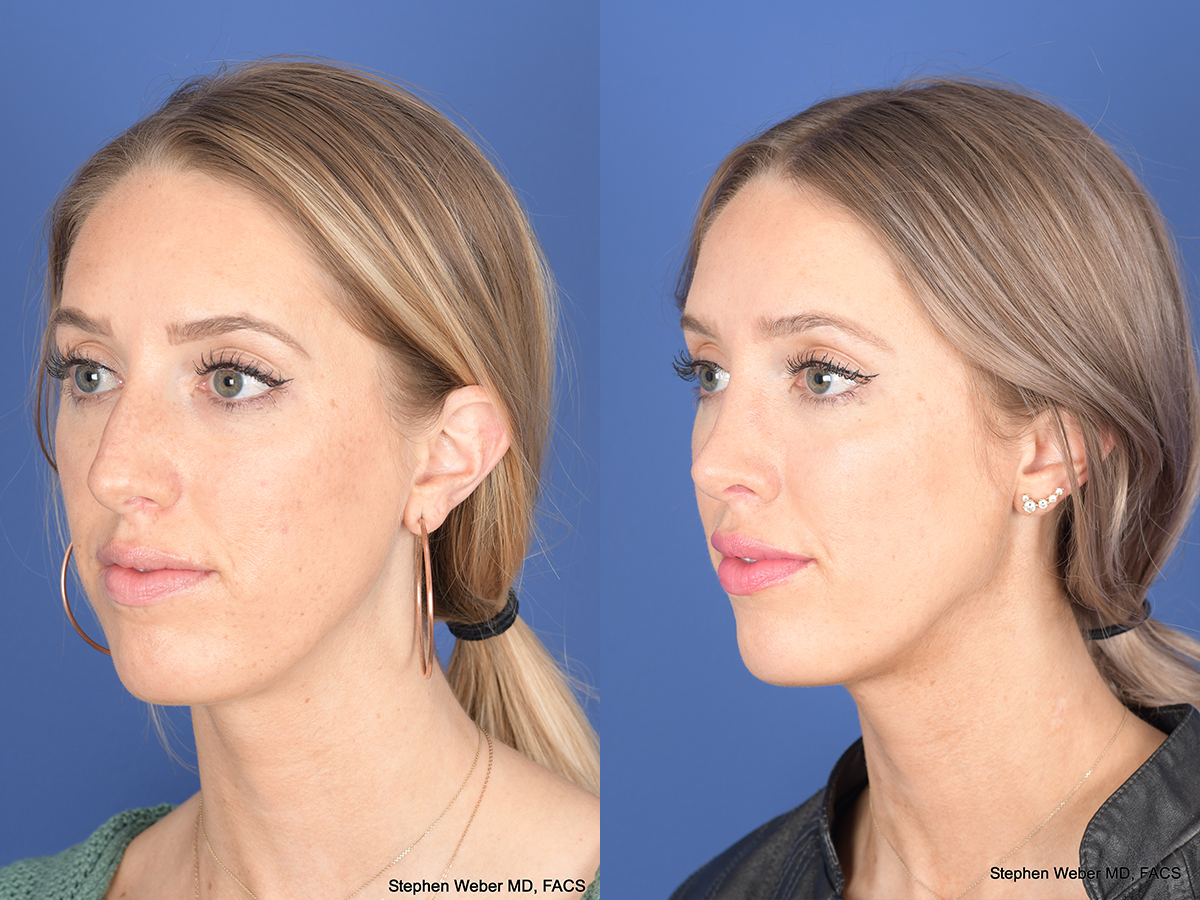 Rhinoplasty Before and After | Weber Facial Plastic Surgery