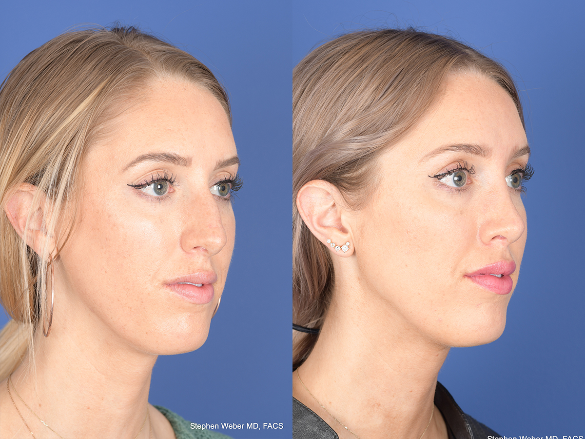 Rhinoplasty Before and After | Weber Facial Plastic Surgery