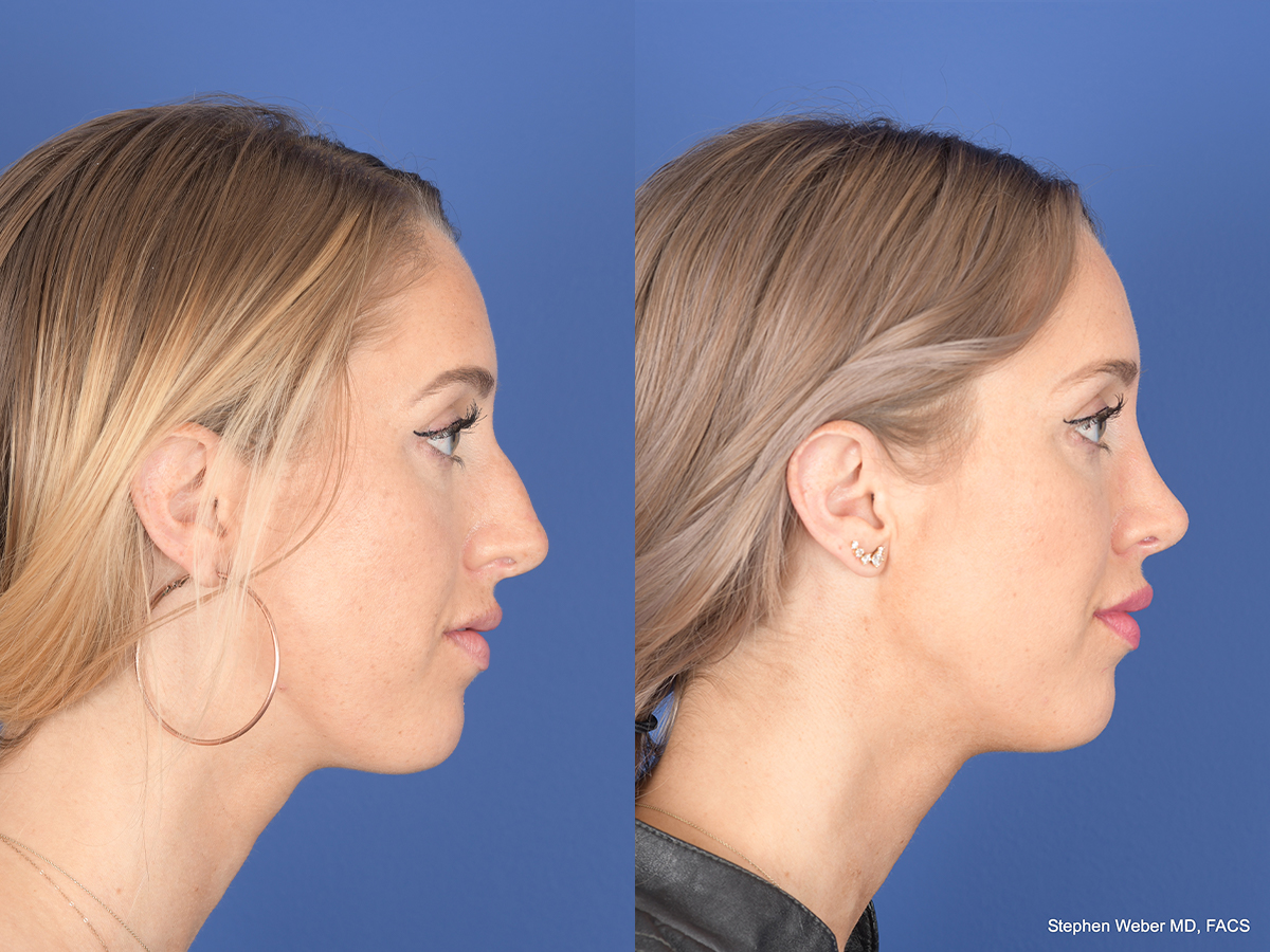 Rhinoplasty Before and After | Weber Facial Plastic Surgery